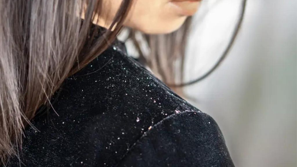 Do you have dandruff? This article is for you